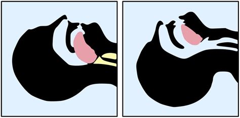 Kiss Of Life: What Is Mouth To Mouth Artificial .